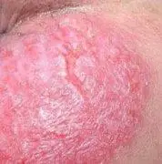 肛门湿疹是怎么形成的?