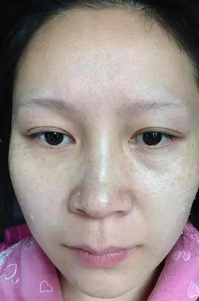 妊娠斑图片 (1)_有来医生