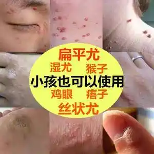 儿童传染性软疣扁平疣面部去除身上水猴子瘊子药膏小姐姐跟我走啦