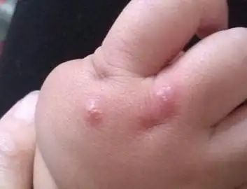 单纯疱疹症状产生的原因是什么