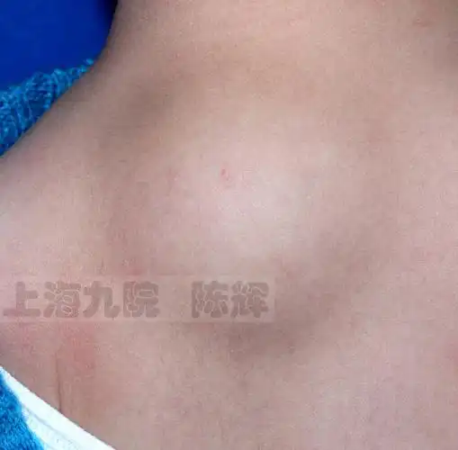 世界——高清大图下的细节辨识和诊疗精要_皮肤血管瘤_疾病介绍_介绍