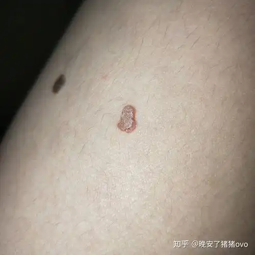 治寻常疣花掉了1000元这正常吗