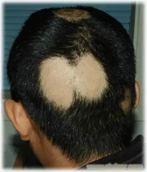 拔毛癖:是由于患者反复牵拉,摩擦毛发引起的脱发,这是自身导致的一种