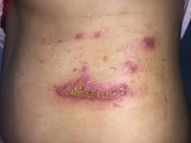 这种小虫子看到后不要拍否则它的酸性体液让你的皮肤受不