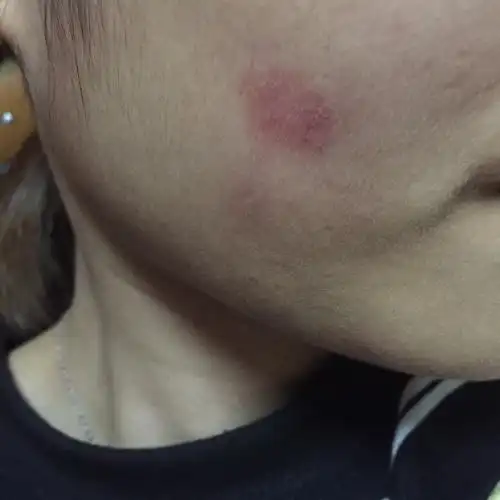 人长狗皮癣的症状图片人得了猫藓初期的样子 脸上猫传染的体癣图片