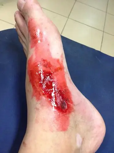 我喝酒了(330)铁雚的雪津,骑电动车在十字路口被小车给撞了.