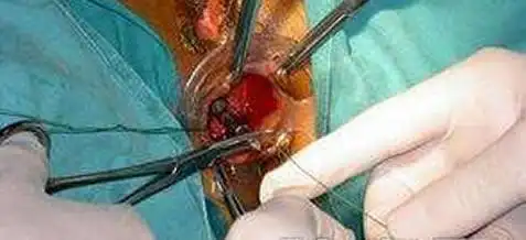 痔疮图片女性痔疮图片症状及其危害介绍图