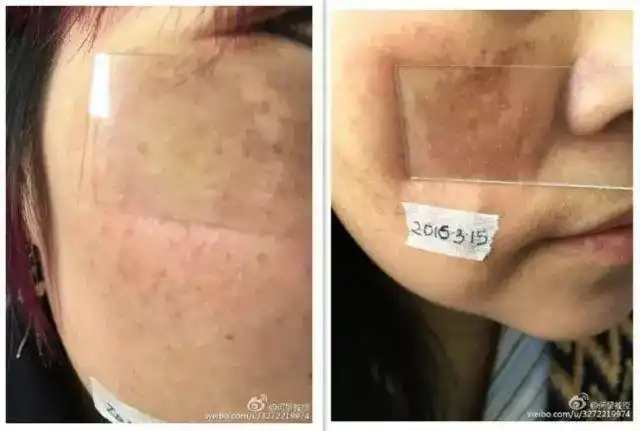 黄褐斑的治疗_黄褐斑_治疗方法_治疗方式 - 好大夫在线