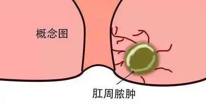 菊部困扰不只是痔疮还要小心
