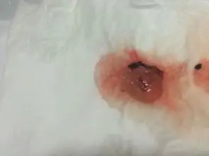 50天自然流产孕囊图片 - 搜狗图片搜索