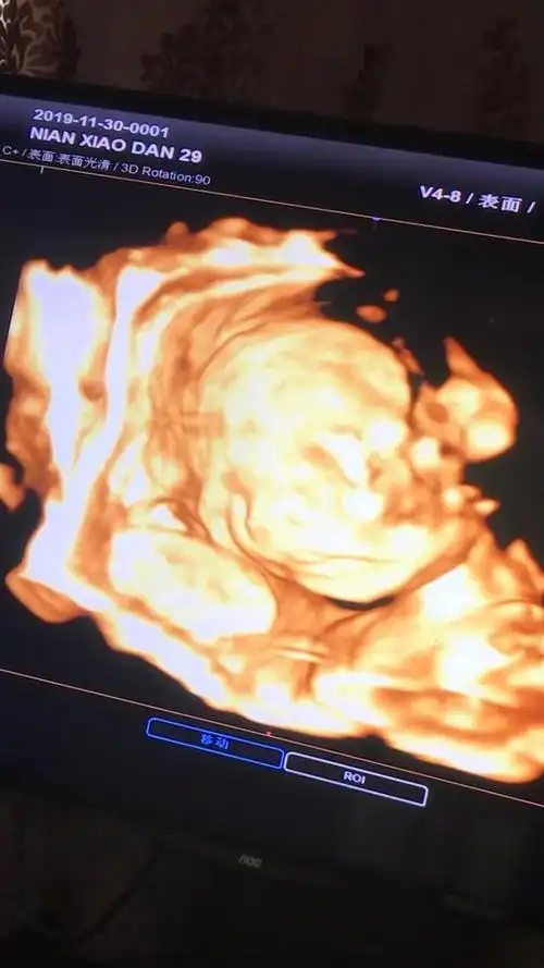 如果继续不予补充,则会出现囟门闭合晚,马鞍头,方颅,佝偻病,鸡胸