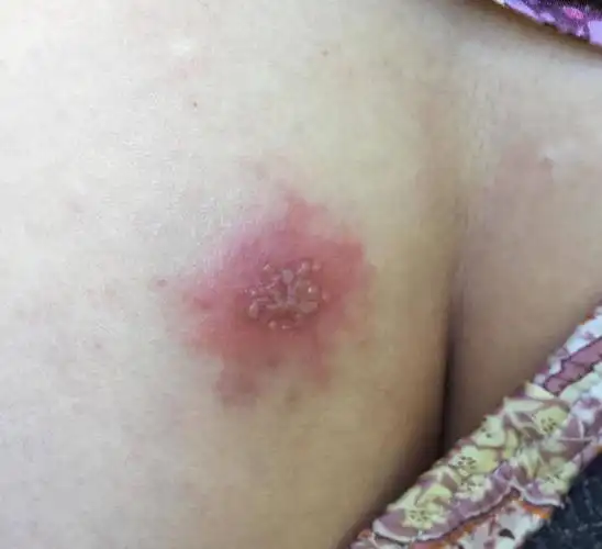 外阴很多水疱还特疼,以为是单纯疱疹却是缠腰龙!