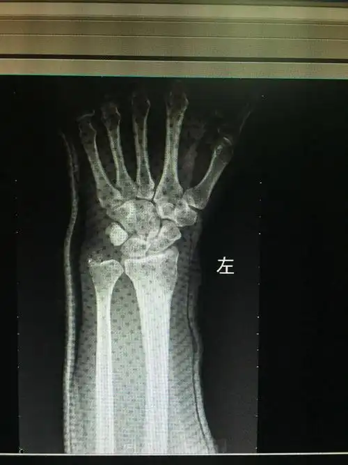 左尺骨茎突骨折
