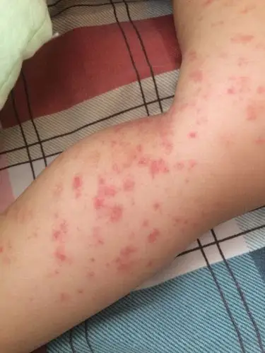 我家小孩二十个月了,最近身上出现红点点,去医院检查尿和血常规,没啥