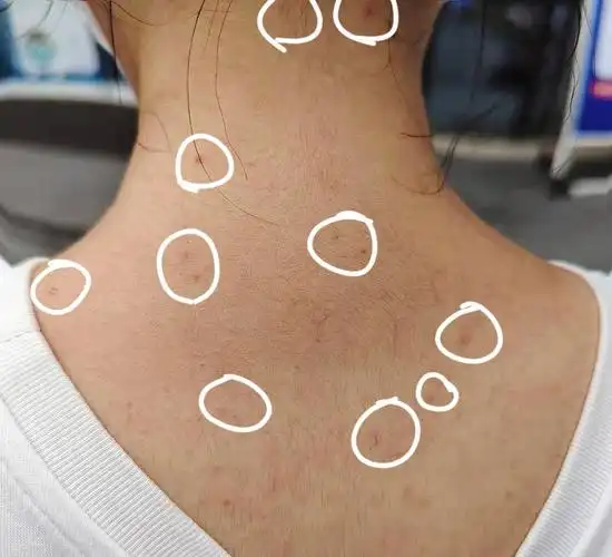 脖子上长了好多红痘痘