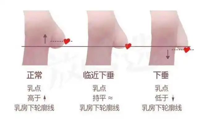 乳房下垂是要怎么判断的