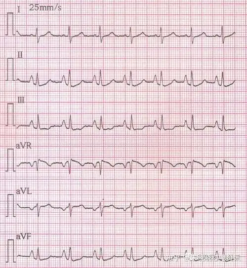 肺型p波的临床及心电图诊断