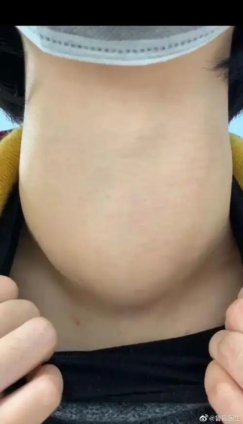 患者的脖子慢慢变粗,但患者及其父母一直希望内科治好甲亢