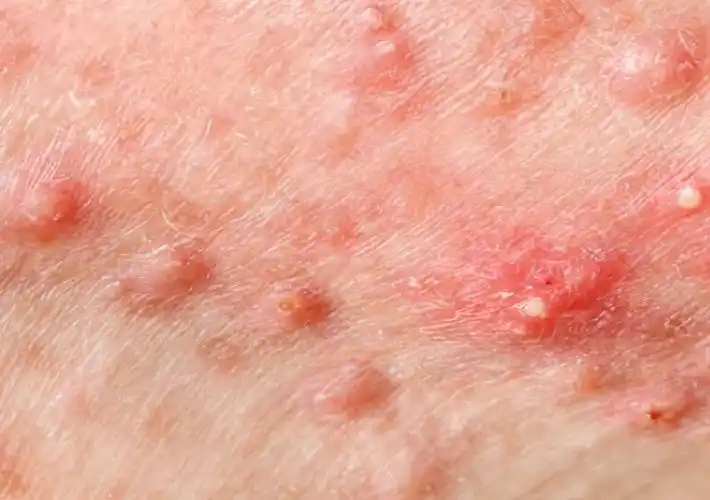 念珠包皮炎图片49