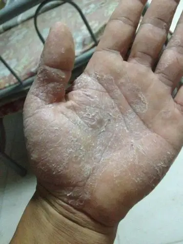 皮肤科.手掌干裂起皮 .日常应该注意那些. 吃什么药 或 涂抹药膏.