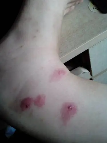 虫咬性皮炎敏症状图片_有来医生