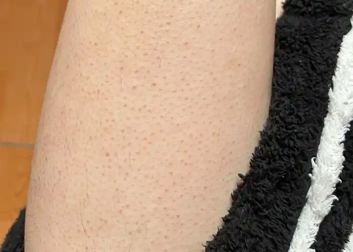 改善鸡皮肤要从具体问题出发才会事半功倍 - 知乎