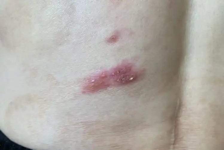 女性背部疱疹初期图片_图文_文章_美咯_让您放心美!