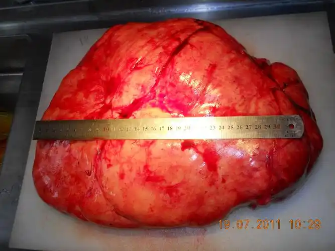 巨大腹膜后脂肪肉瘤 - 好大夫在线