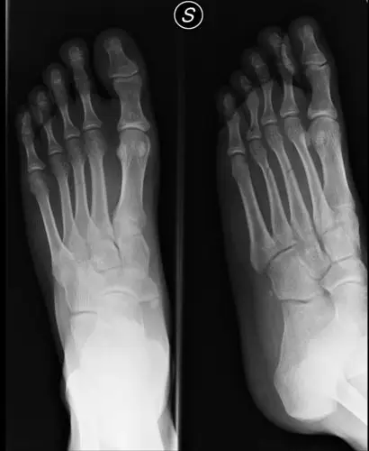 脚掌骨骨折 包了石膏一个月 然后又过了40天. 还是不能正常走路.