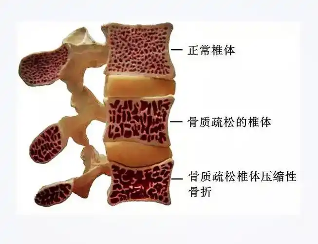 脊柱骨专家提醒您:老年人胸腰椎骨折,切不可静养丨这种技术可不开刀