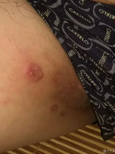 腹股沟处的皮肤1