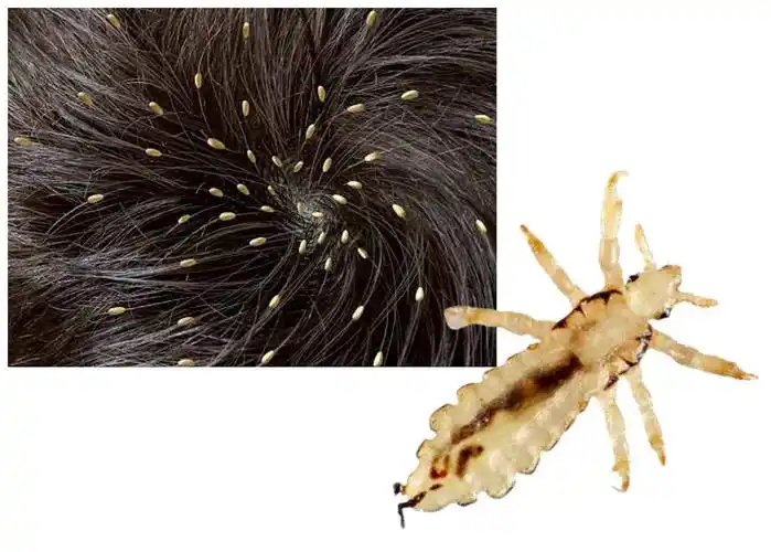 一个孩子头发的照片,上面长了许多虱子卵,叫作虱卵.