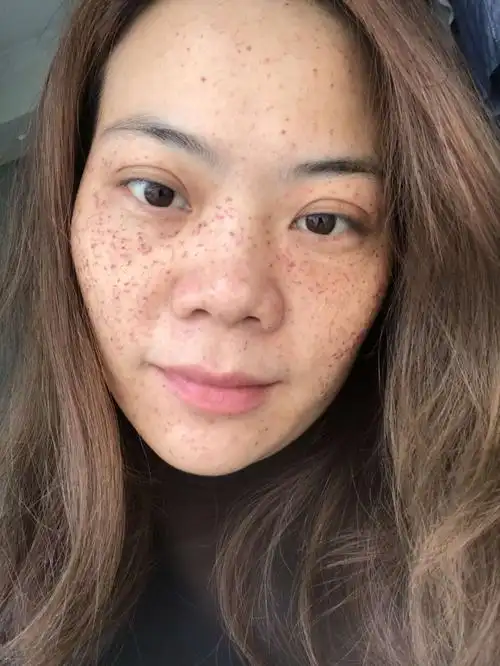 4.5雀斑 黄褐斑无创技术