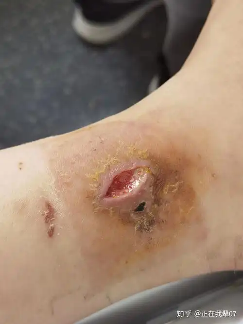 热水袋低温烫伤记录图片