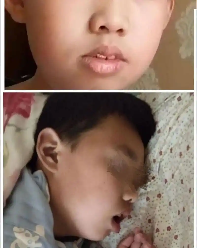 快来看看腺样体面容有多丑|你也希望自己的孩子变成这样吗?