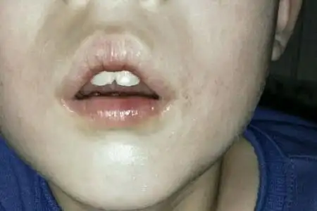 首大石萍:小儿腺样体发炎肥大有哪些危害_手机搜狐网