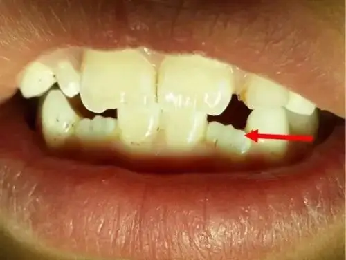 新换的恒牙边缘呈锯齿状