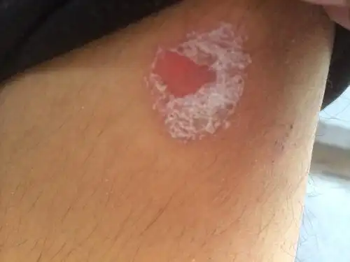 6 2008-09-22 男性生殖器龟头上长白色小点,而且痒,并有暴皮是什么病