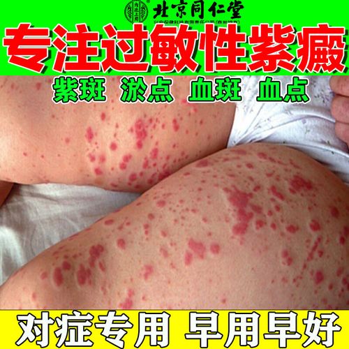 同仁堂过敏性紫癜的治疗外用药紫癜性消除红色瘀斑血斑血点膏皮下出血