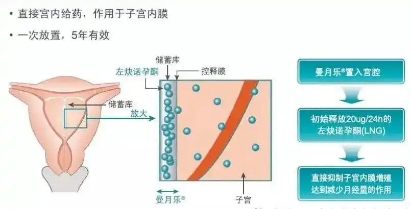曼月乐环——可治疗多种妇科疾病_子宫内膜息肉_治疗方法_治疗方式