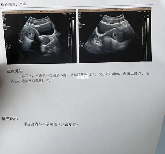 孕早期四周_孕囊_母婴_孕产经验