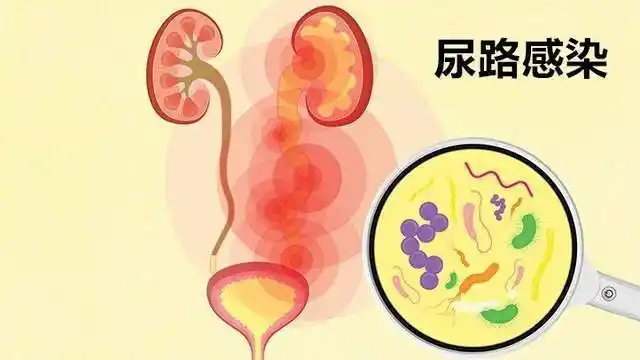 盛夏时节女性糖友更易遭受尿路感染该如何应对