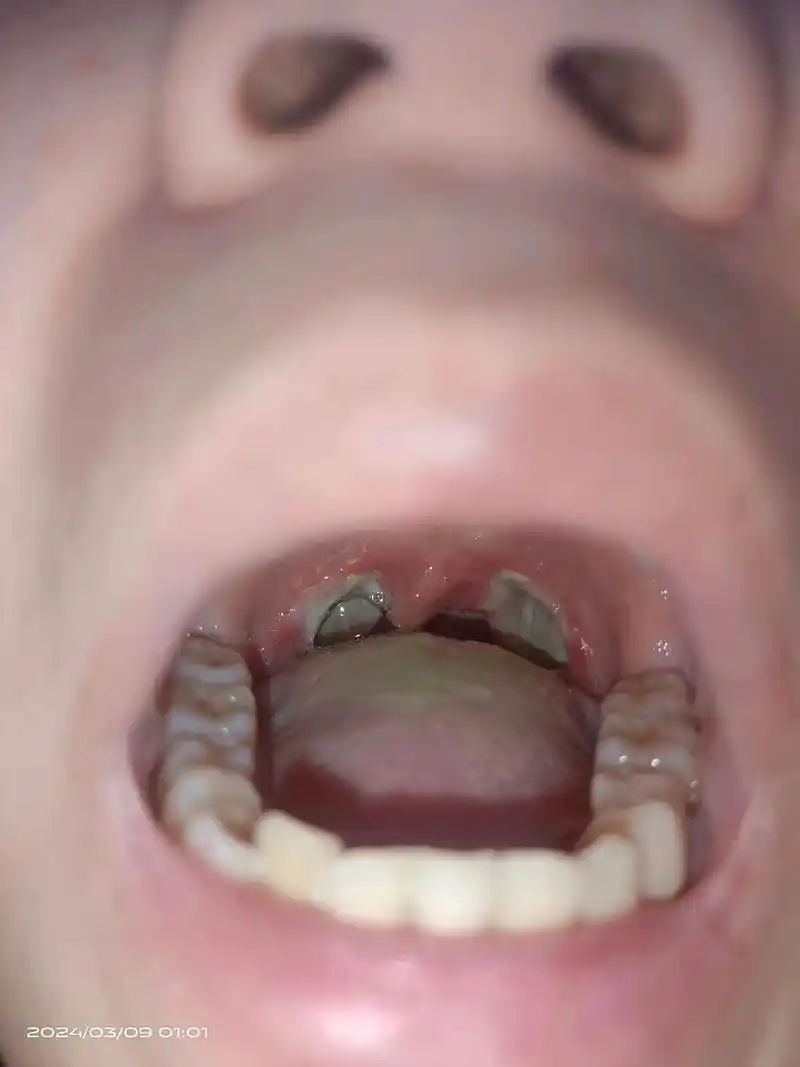 割完扁桃体手术的第三天.