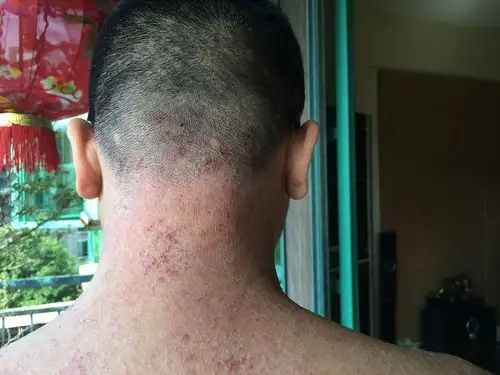 长,之前就医很多次有说过神经性皮炎,脂溢性皮炎也有,中医有说血热的