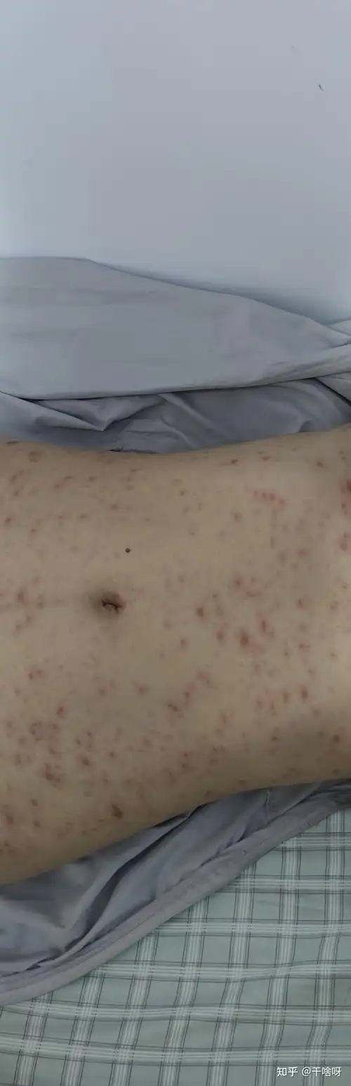 玫瑰糠疹不可怕