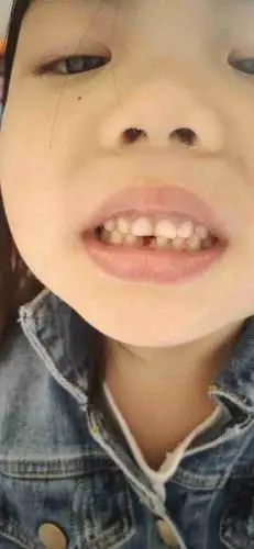 五岁两个月大的孩子掉牙齿?