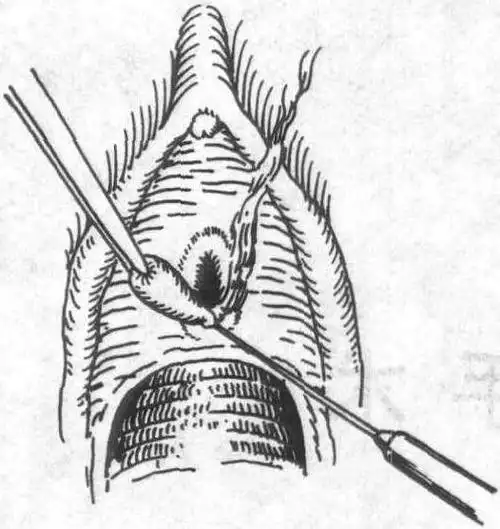 第一节 尿道肉阜切除术-妇产科手术规范-百科知识