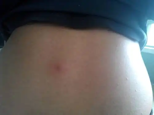 问:我后背中间起了一个米粒一样的小疙瘩 半年多了 不疼不痒 昨天突然