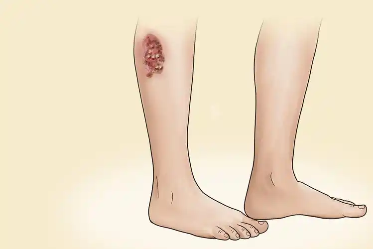 伤口愈合肉芽图片