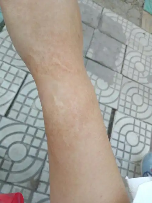 十多年了,请问要怎么把疤痕遮住?